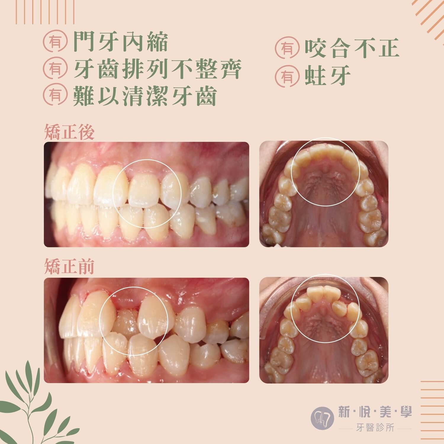  門牙亂不怕！ 牙齒整齊清潔 就 簡單！的第2張圖片